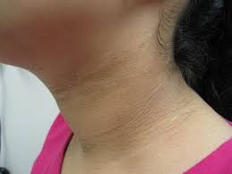 theindiaprint.com is your neck black now try these five simple fixes and youll see improvements quic