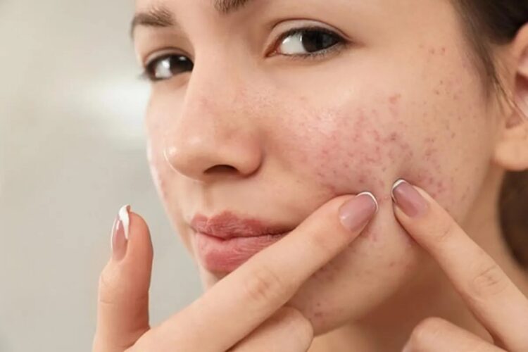theindiaprint.com the beauty of your face is being ruined by pimples try these five at home cures to