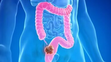 theindiaprint.com 5 colon cancer early symptoms you should never ignore image2 2024 02 70adcbd037dce