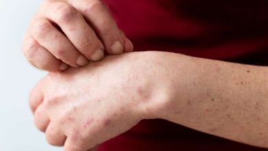 theindiaprint.com dermatomyositis what is it understand the signs and causes of this uncommon autoim