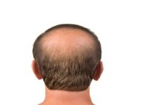 theindiaprint.com use these homemade hair masks to treat bald areas bald patches 11zon